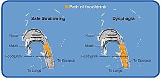 Nutrition Management Of Dysphagia