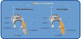 nutrition management of dysphagia