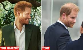 Prince Harry's hair is 'thinning on top ...