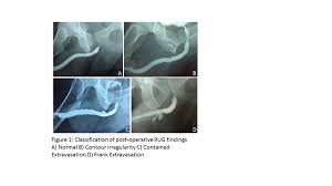 Image result for Retrograde Urethrogram