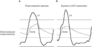 Image result for Left Ventricular Outflow Obstruction
