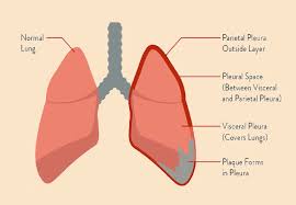 Lung cancer is a serious illness which none of us wish to face. Know About Mesothelioma Cance Delhi Cancer Hospital