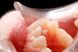 Odontopediatria Cuando Los Dientes De Leche No Se Caen Solos Clinica Dental En Cordoba Redondo Y Cardoso