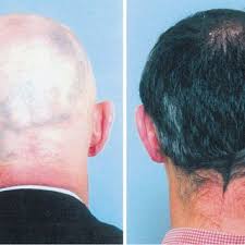 Hair loss is a dilemma that can take up many forms. Pdf Randomized Trial Of Aromatherapy Successful Treatment For Alopecia Areata