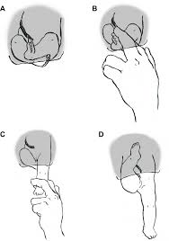 Image result for Breech Delivery