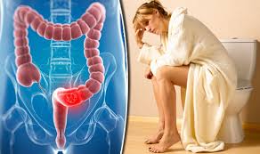 Most common signs or symptoms that both rectal cancer and hemorrhoids are bleeding from the rectum, more gas, stool size, and diarrhea. Bowel Cancer Symptoms Signs Of Disease Similar To Piles Express Co Uk