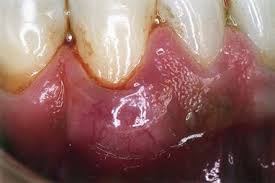 Image result for Periodontal Abscess