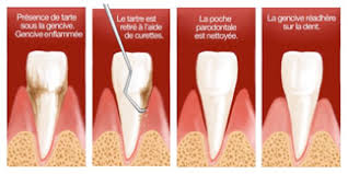 [middle english tartre, from old french tartare, from medieval latin tartarus, alteration (influenced by latin tartarus, tartarus) of persian tātār; Tartre Clinique Dentaire Et D Implantologie De Magog Inc