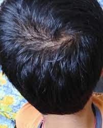 I M 17 And It Looks Like I M Balding Already I Use Hair Oil Everyday And Shower Frequently Yet It S Cool Blonde Hair Beige Blonde Hair Beige Blonde Hair Color