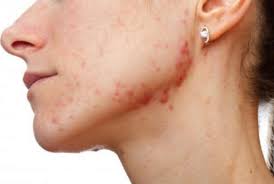 We recommend roc's retinol correxion. How To Get Rid Of Pimple Acne Scabs Fast On Face 36 Home Remedies Home Remedies For Acne Acne Remedies Acne Scabs