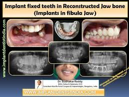 After radical cancer surgery, the oral rehabilitation of a patient is a demanding procedure. Search Free Fibula Dental Implant Studio Bangalore
