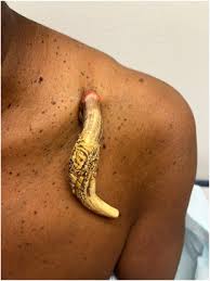 Image result for cornu cutaneum)