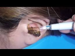 Ear wax removal's channel, the place to watch all videos, playlists, and live streams by ear wax removal on dailymotion. Earwax Removal Videos Are The Disturbing Internet Trend You Never Asked For