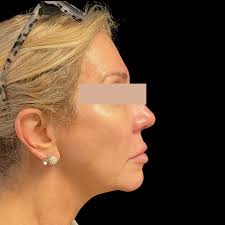 Face Procedures Archives