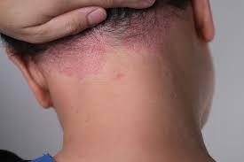 Image result for psoriasis