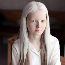 Girl with albinism and heterochromia