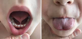 See full list on mayoclinic.org Hidden Tongue Ties In Infants Have Scant Scientific Backing