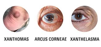 Image result for Hypercholesterolemia