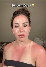 Fruit of The Earth Aloe Vera Gel Sunburn