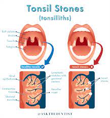 Maybe you would like to learn more about one of these? Tonsil Stones Symptoms Causes And How To Remove Ask The Dentist