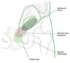 Image result for Groin Disruption