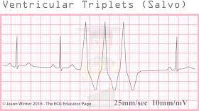 Ecg Educator Blog Ventricular Ectopics Paramedic School Cardiac Nursing Blog Visitors Ventajas de las ventanas de pvc. ecg educator blog ventricular