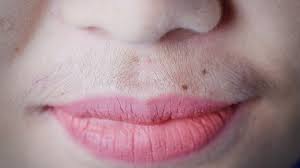 The chin, cheeks, and the upper lip. Girl With A Moustache Or Small Vellus Hairs Under Her Nose