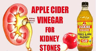 Very Easy Ways To Use Apple Cider Vinegar For Kidney Stones Kidney Stones Apple Vinegar Apple Cider