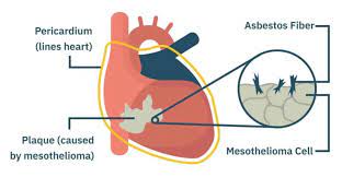 Mengecat asbes bukan solusi untuk mencegahnya asbes terhirup oleh kita, asbes yang rusak walaupun dicat tetapakan menimbulkan dampak yang sama. 4 Mesothelioma Kanker Berbahaya Dan Mematikan Karena Asbes Bebaspedia Com