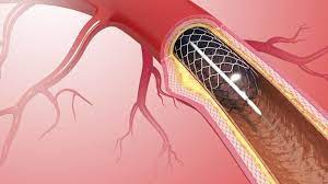 Jeder Funfte Stent Uberflussig Wissen Srf