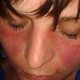Image result for if you have lupus what is treatment