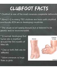 Image result for Clubfoot