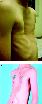 In severe cases, pectus excavatum can look as if the center of the chest has been scooped out, leaving a deep dent. Current Management Of Pectus Excavatum A Review And Update Of Therapy And Treatment Recommendations American Board Of Family Medicine