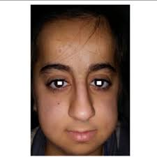 Iris-related parameters as measured by ASOCT. A = iris cross-sectional...