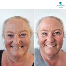 Discover a stunning smile that's uniquely yours ✨ Affordable Dental's Dr Mina  Rizk used four anterior crowns and in-chair whitening to create a  beautifully matched result for his patient. Ready to see