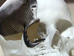 Medical First In Brazil 3d Printed Titanium Skull Successfully Implanted In 23 Year Old Woman Prints 3d Printing 3d Printing Business