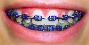 Black And White Braces Color Pin By Sophia Petrucci On Colorful Braces Cute Braces Colors Braces Colors Dental Braces Colors