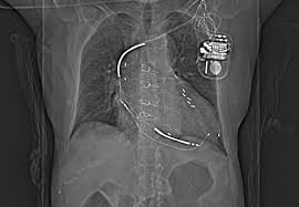 In most cases, you can lead a normal life with an icd. Do Implanted Pacemaker Leads And Icd Leads Cause Metal Related Artifact In Cardiac Pet Ct Journal Of Nuclear Medicine
