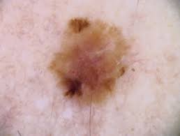 Understanding liver cancer is important if you want to develop an effective treatment plan and live a long and healthy life. Childhood Melanoma Dermnet Nz