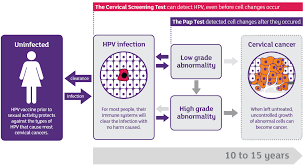 Cervical cancer, or cancer of the cervix, begins on the surface of the cervix. Hpv And Cervical Cancer Cancer Institute Nsw