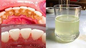 Take care of your oral health between dental visits. How To Remove Dental Plaque In 5 Minutes Without Going To The Dentist White Teeth Home Remedies Youtube