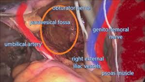 Laparoscopic demonstration of pelvic anatomy by dr r k mishra at world laparoscopy hospital. Laparoscopic Pelvic Lymphadenectomy In 10 Steps Let S Make It Easier Gynecologic Oncology