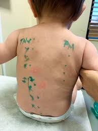 A milk protein allergy most often happens in babies who are fed cow's milk formula. 15 Month Update To Breastfeeding A Baby With Mspi Hungry Hobby