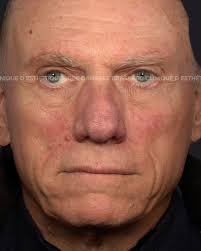 Venez rencontrer nos infirmières cliniciennes pour une consultation  gratuite ♥️ Nous avons hâtes de vous rencontrer ✨ T 514-396-5351 💌  esthetique@cliniqued.com