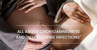 Image result for Chorioamnionitis