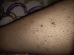 Ingrown hair on your legs can also be caused by a buildup of dead skin cells clogging hair follicles. Can Someone Please Help Me How We Can I Treat These Ingrown Hair Problems And These Marks On Legs Nykaa Network