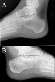 Image result for Calcaneus Compression Fracture