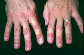 Arthritis is when joints become inflamed and painful. Reactive Arthritis Musculoskeletal And Connective Tissue Disorders Msd Manual Professional Edition