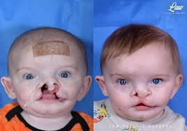 Image result for Cleft Lip