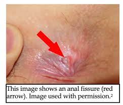 What do ingrown hairs look like? Anorectal Disorders A Pain In The Rear Emergency Medicine Board Review
